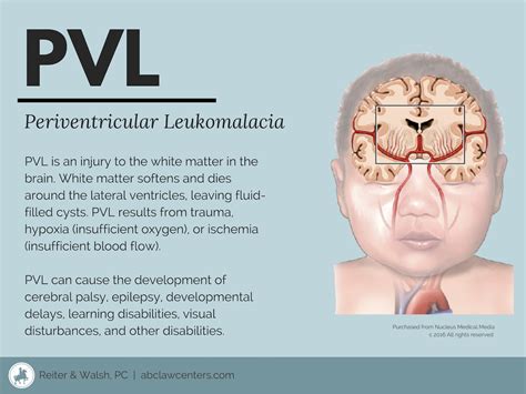 Periventricular Leukomalacia (PVL) .